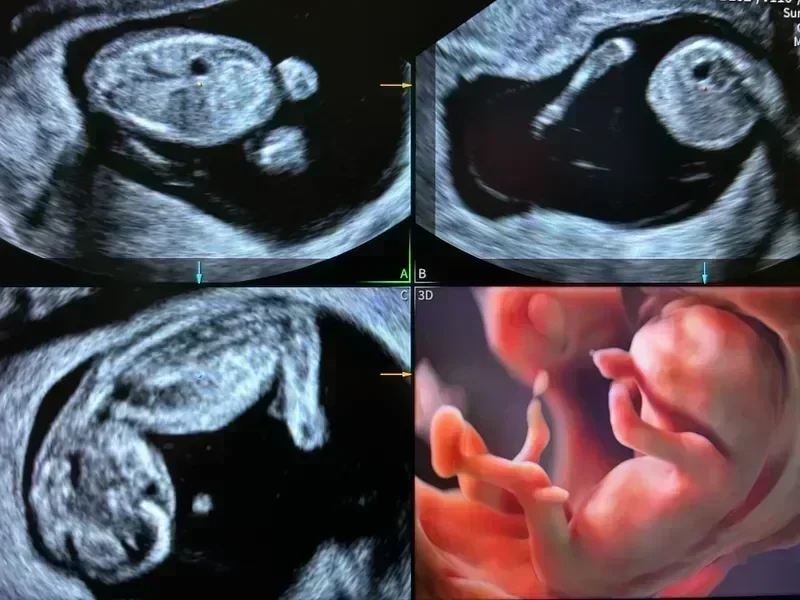 Advanced fetal ultrasound scan