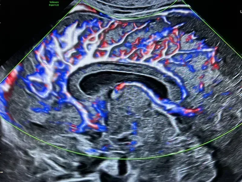 Third trimester scan and growth monitoring in the third trimester